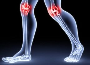 Sebab -sebab perkembangan arthrosis lutut
