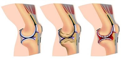 Peringkat perkembangan arthrosis sendi lutut