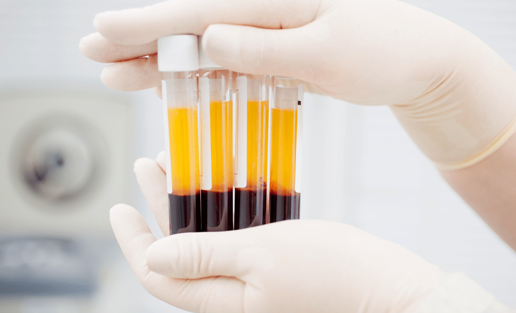 Plasma kaya platelet untuk terapi PRP untuk arthrosis